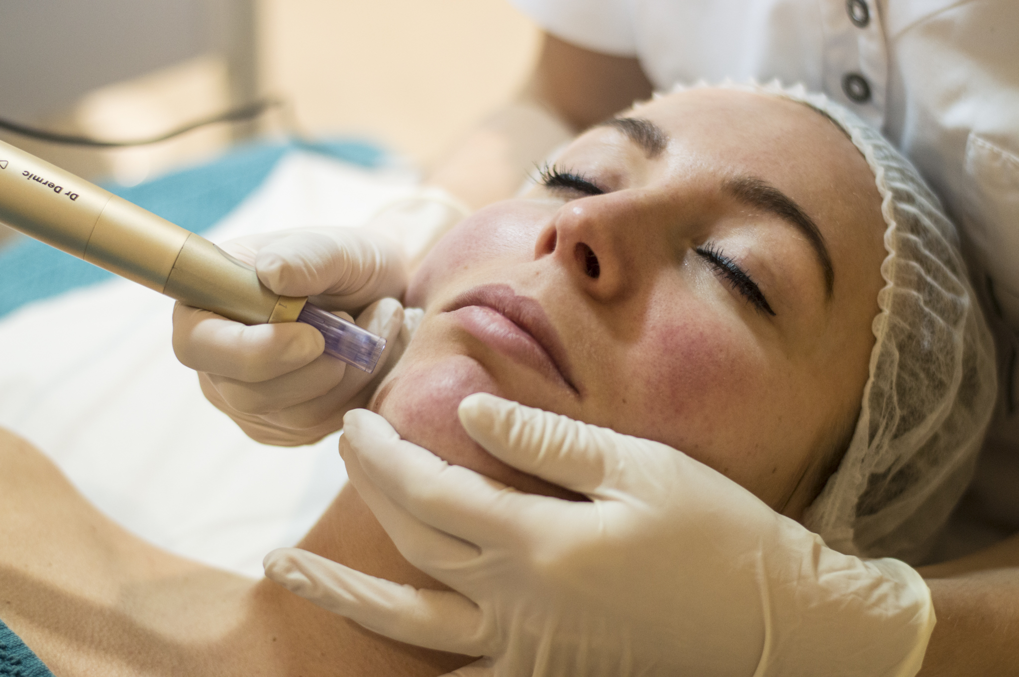 Microneedling