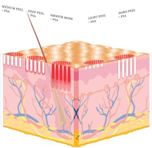 Foto laserpeel